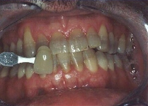 Тетрациклиновые зубы